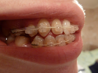 A side on photograph of teeth with ceramic fixed braces at week 10 of treatment