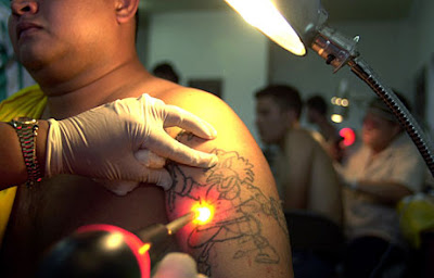 The laser operation to eliminate tattoo 