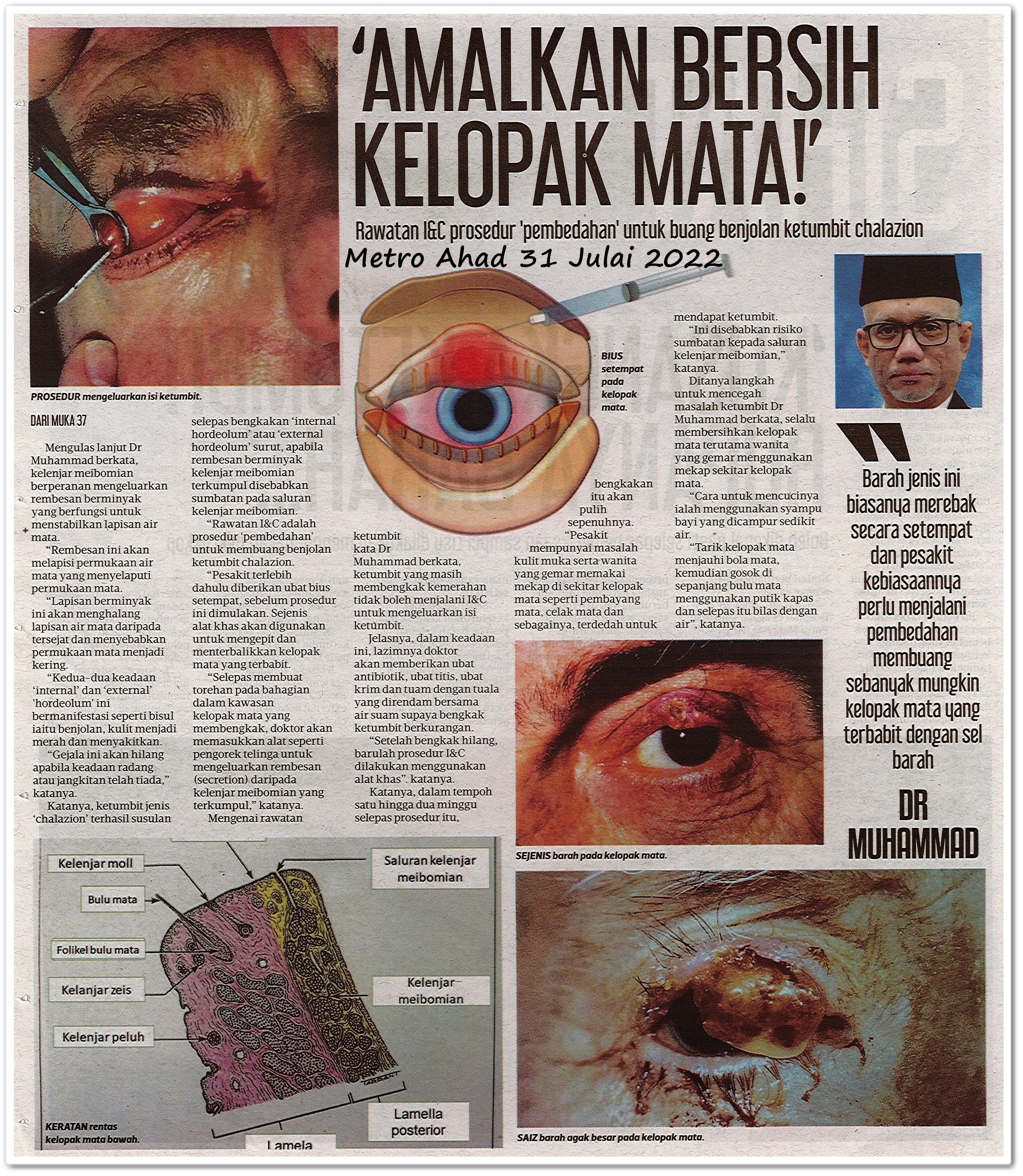 'Kusangka ketumbit rupanya barah' ; Amalkan bersih kelopak mata! - Keratan akhbar Metro Ahad 31 Julai 2022