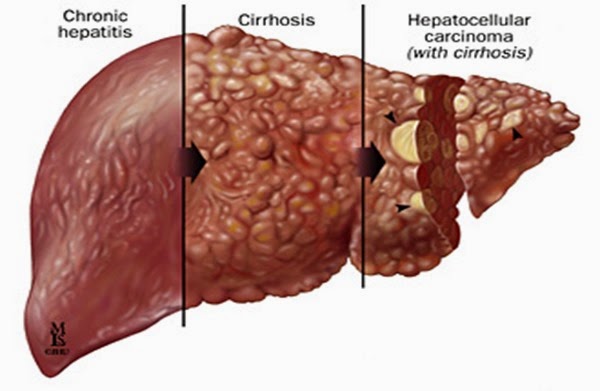 hepatitis-clivers fucked