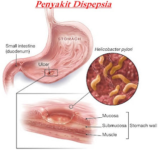 Akibat Penyakit Dispensia