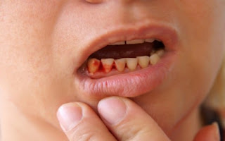 Triệu chứng viêm chân răng-1