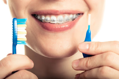 Cách chăm sóc răng miệng sau khi niềng răng móm