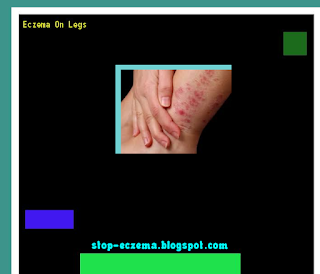 Eczema on legs