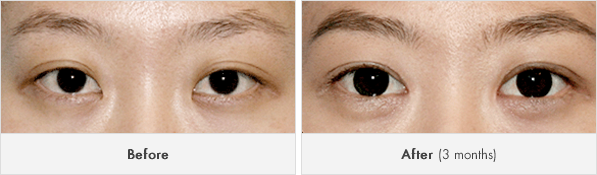 짱이뻐! - Korean Eye Plastic Surgery - Eyelid Revision