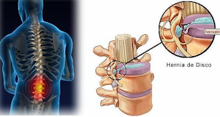 Aprenda o Tratamento Definitivo para Hérnia de Disco lombar