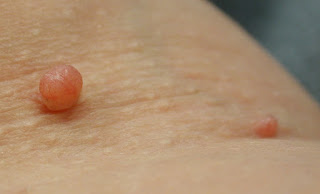 moles and skin tags removal