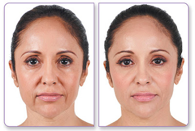 Juvederm skin care at Smoothus medical spa