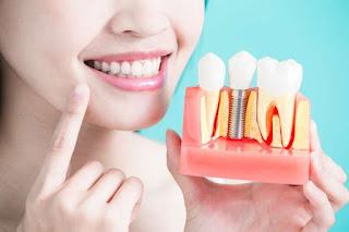 Cấy ghép implant cho người thiếu răng bẩm sinh-2