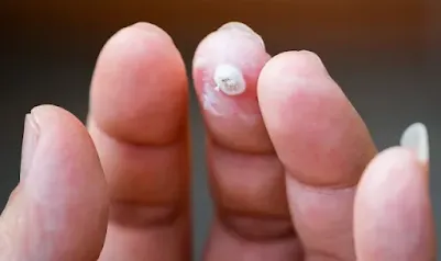 Stages Of A Wart Falling Off