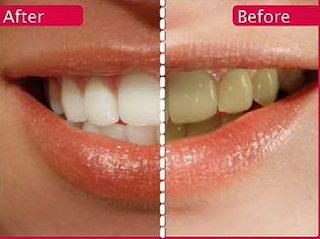 Dazzle White Pro Bleaching Teeth System