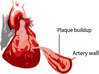 Acute Myocardial Infarction - Heart Attack