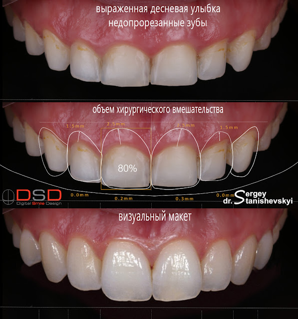 Виниры Киев Станишевский Сергей накладки коронки керамика керамические Digital Smile Design (DSD)