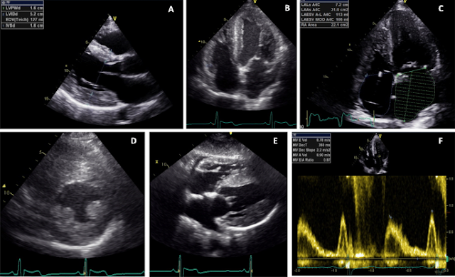 Echocardiogram features of Anderson-Fabry disease. a Transthoracic echocardiogram (TTE) parasternal long-axis view (PLAX) demonstrating concentric LVH with an interventricular septum (IVS) and left ventricular posterior wall (LVPW) diameter of 16 mm. b Apical 4 chamber view on TTE demonstrating the presence of concentric LVH. c Moderately dilated left atrium (31 cm2) on apical 4-chamber TTE view. d TTE parasternal short-axis view (PSAX) at mid-ventricular level demonstrating concentric LVH and hypertrophied papillary muscles. e TTE subcostal view demonstrating concentric LVH. f Pulsed wave Doppler across mitral valve inflow demonstrating impaired relaxation (grade 1 diastolic dysfunction) with E:A ratio of 0.87