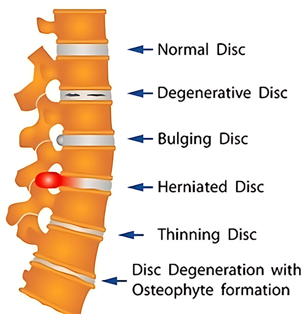 Herniated disc vs Bulge disc