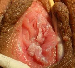 Obat Kutil Genitalis (Kondiloma Akuminata)
