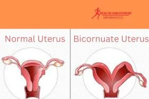The bicornuate uterus : How does it affect your pregnancy