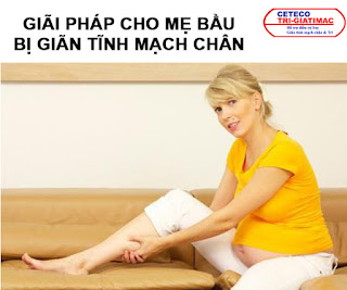 Giải pháp cho mẹ bầu bị giãn tĩnh mạch chân