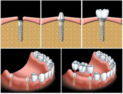 Làm cầu răng cửa có hiệu quả bằng trồng răng implant không?-2