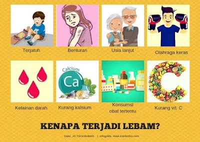 Kenapa terjadi lebam?