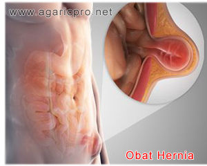 Obat Hernia Herbal Paling Terkemuka Dan Mengesankan Keampuhanya