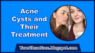 Acne Cysts and Their Treatment