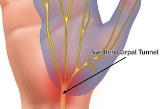 hội chứng ống cổ tay