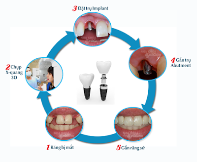 Quy trình tiến hành cấy ghép răng Implant nha khoa