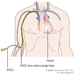 "PICC"