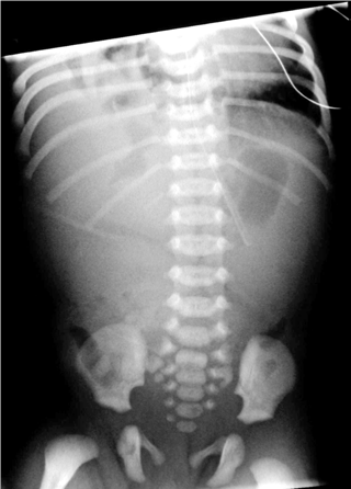 Foto ilustrasi pada soal UKMPPD (uji kompetensi mahasiswa program profesi dokter indonesia) Gambar pencitraan radiologis x-ray hernia diafragmatika strangulata pada bayi laki laki-laki, 5 hari, datang ke IGD RS dengan keluhan utama sesak nafas sejak kemarin. Bayi menangis lebih keras dan tampak kesakitan terutama saat kedua kaki diangkat. TTV: Nadi 140x/m, RR 40x/m, Suhu 38 derajat celsius hernia inkarserata, Intususepsi, atresia bilier