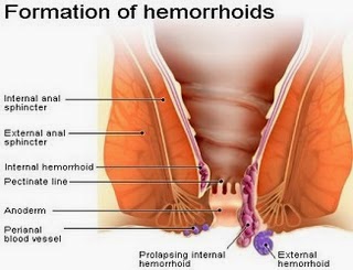 Obat Wasir Bahan Alami, mengobati wasir, wasir atau ambeien