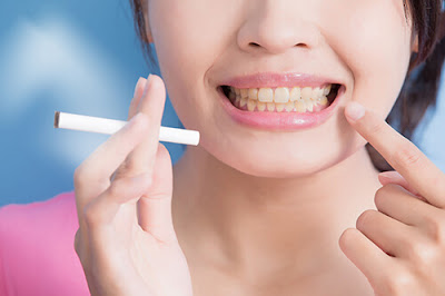 Nguyên nhân răng bị ố vàng