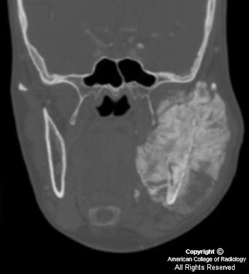 multiple myeloma