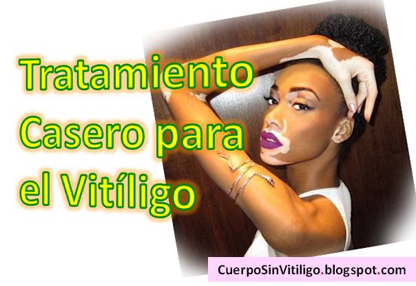 medicina-natural-tratamiento-casero-para-el-vitiligo