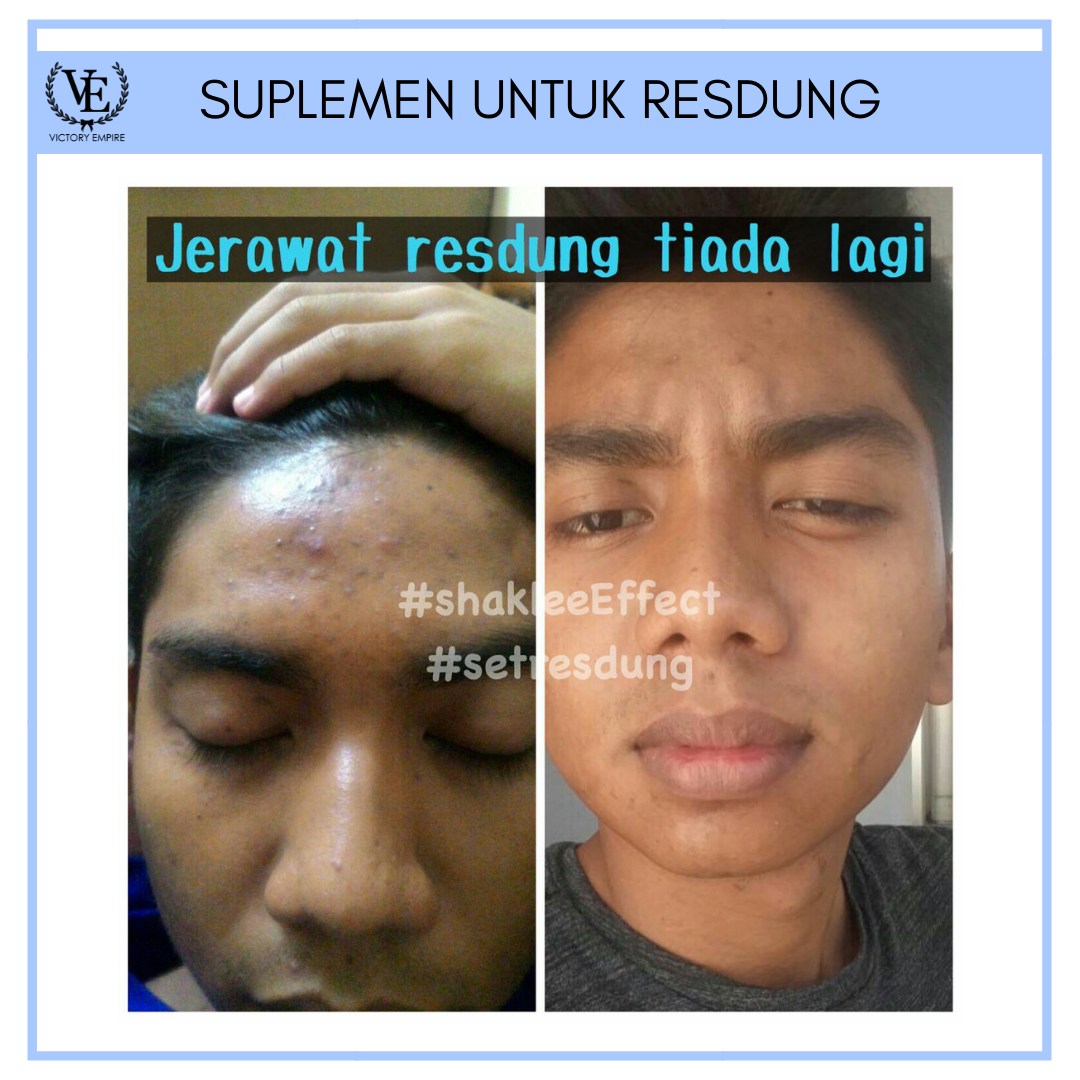 Testimoni Set Resdung Shaklee