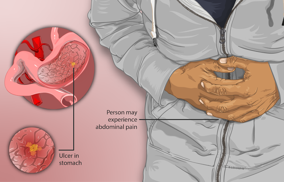 Stomach burning after eating? May be the problem of ulcers!