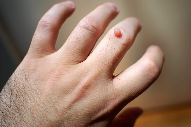 how to get rid of a wart fast and painless