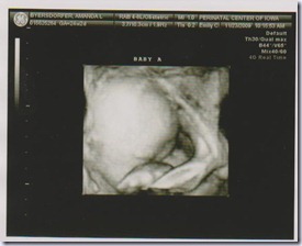 Baby A 24W2D
