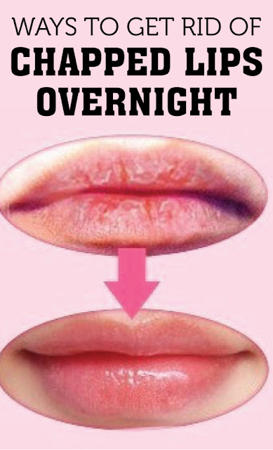 Ways to Get Rid of Chapped Lips Overnight