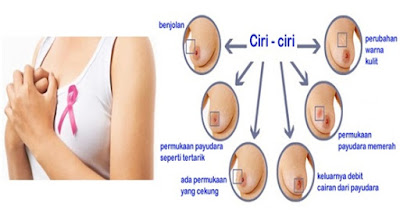 Obat Kanker Payudara Dengan Ekstrak Sirsak