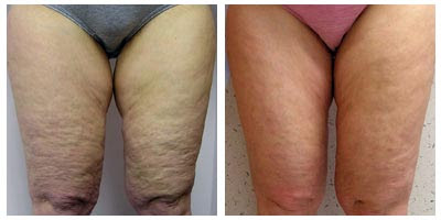 Mesotherapy Pictures