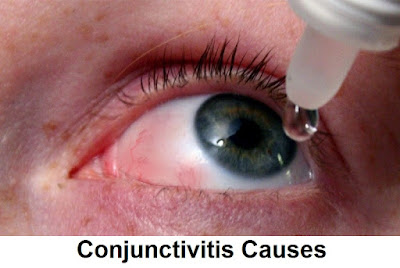 What Causes Pink Eye Conjunctivitis In Adults And Children | conjunctivitis in toddlers | signs symptoms treatment | what is conjunctivitis | viral bacterial