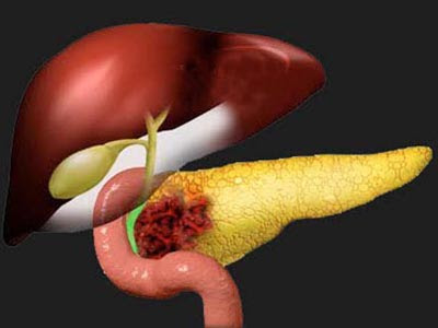 Inflammation Of The Chronic Pancreatitis : What Causes, Symptoms And Treatment Of Chronic Pancreatitis