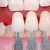 Cách sửa răng khểnh phổ biến