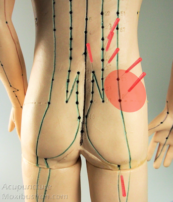 Acupuncture Points - maps for sciatica - Standard and Non-Standard Sciatica Acupuncture Points