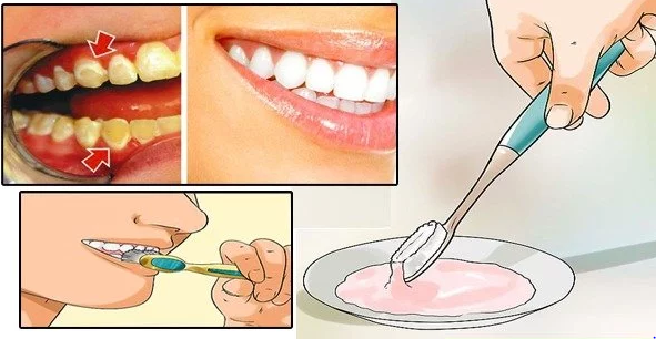 Get Rid Of Dental Plaque In Only 5 Minutes! This Will Change Your Life!