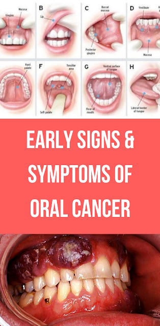 Early Signs & Symptoms of Oral Cancer