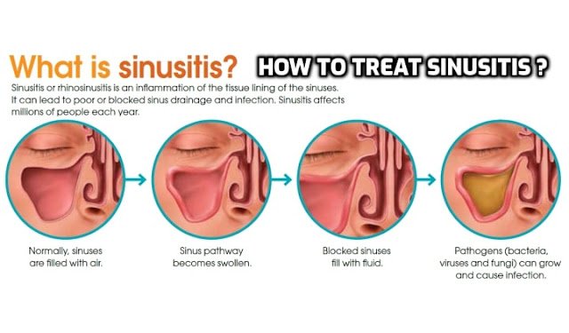Treating My Sinus Problems - Sinus Infections are the ones that affect the cavities, called sinuses, in the bones near the nose. An inflammation of the sinuses causes a disease called sinusitis. Home remedies for treating sinusitis vary from inhaling steam, intaking warm fluids, applying a paste of cinnamon with water, to having jalapeño peppers and ripe grapes' juice.
