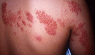 Herpes Zoster di Punggung dan Ketiak