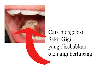 CARA MENGATASI SAKIT GIGI YANG DISEBABKAN OLEH GIGI BERLUBANG